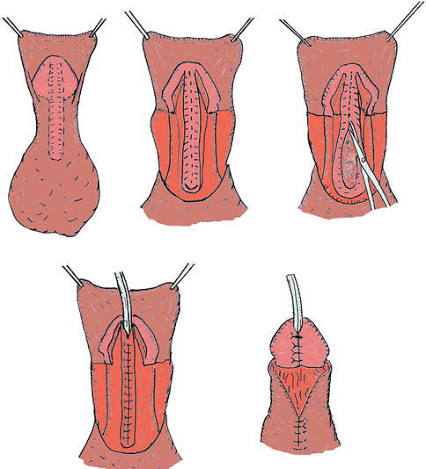 Medical treatment for urinary stones